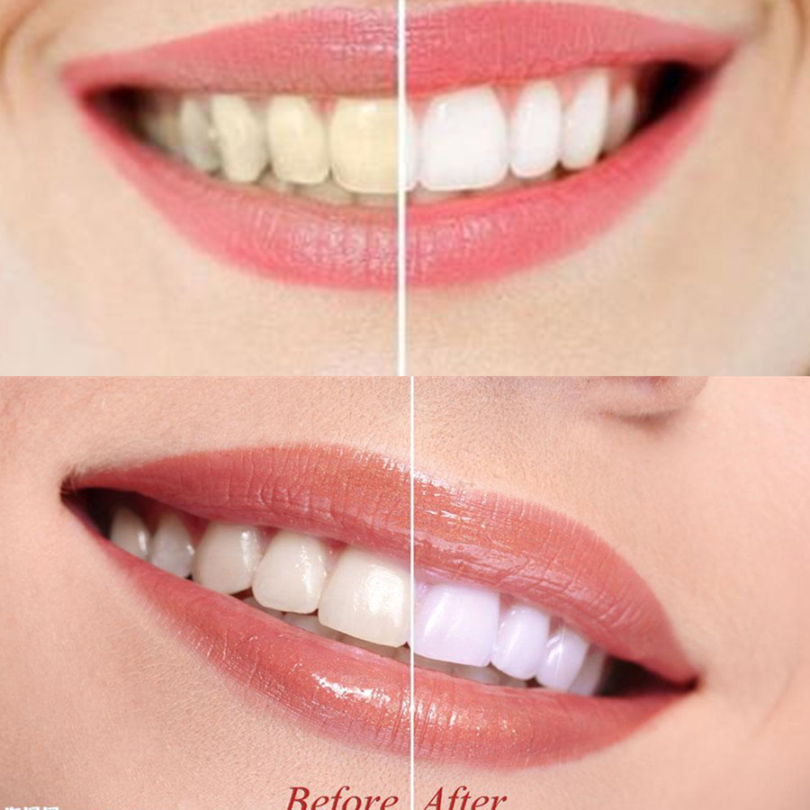 Than Tre Răng Răng Nha Khoa De - đánh giá và giá Teeth Whitening Q&M