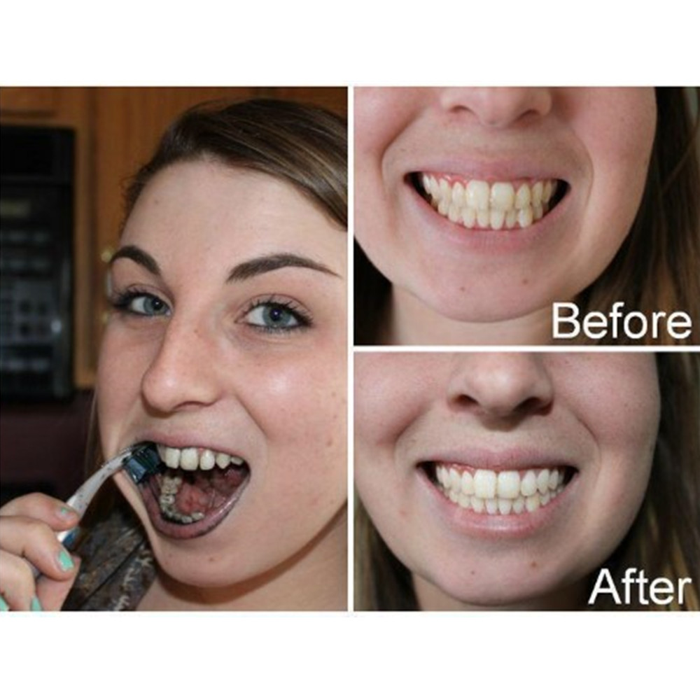 Than Tre Răng Răng Nha Khoa De - đánh giá và giá Teeth Whitening Q&M