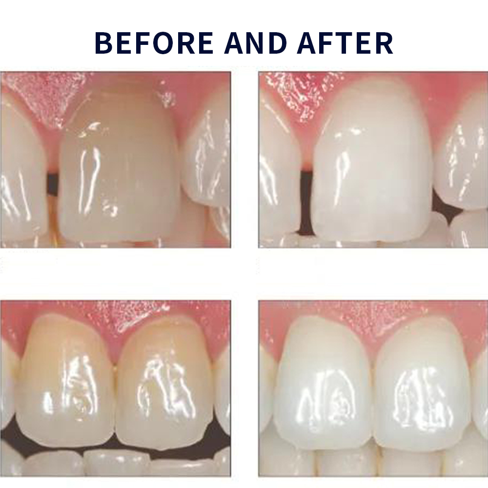 Opalescence Whitening 20% PF 2 - đánh giá và giá Teeth Whitening Q&M