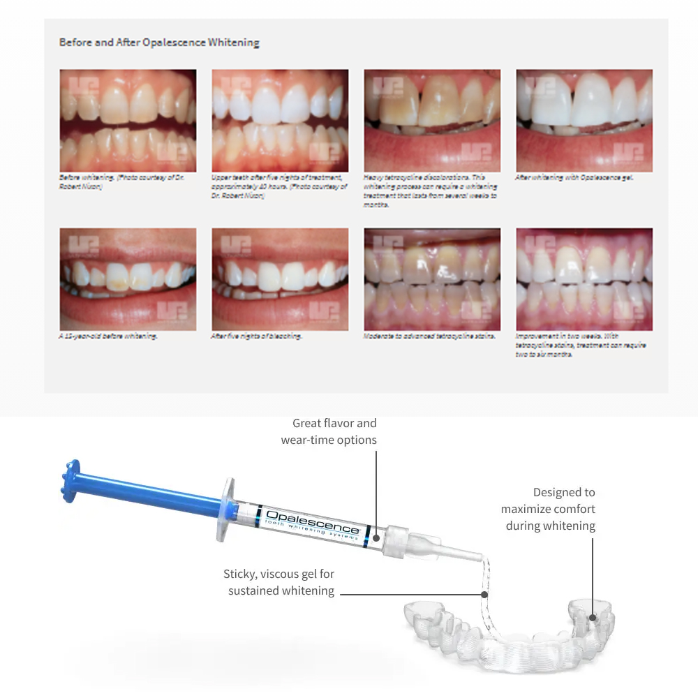 Opalescence Whitening 20% PF 2 - đánh giá và giá Teeth Whitening Q&M