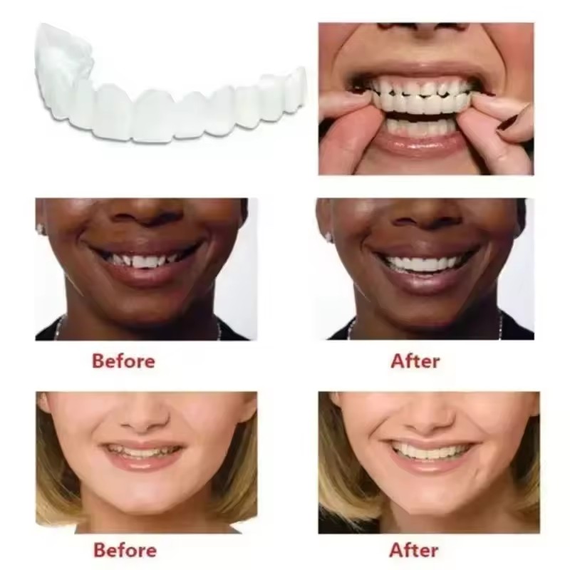 Teeth Veneers Whitening Dentur - đánh giá và giá Teeth Whitening For Braces