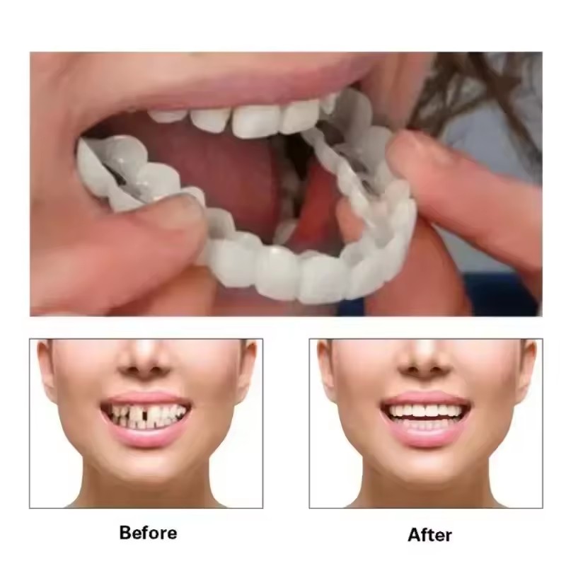 Teeth Veneers Whitening Dentur - đánh giá và giá Teeth Whitening For Braces