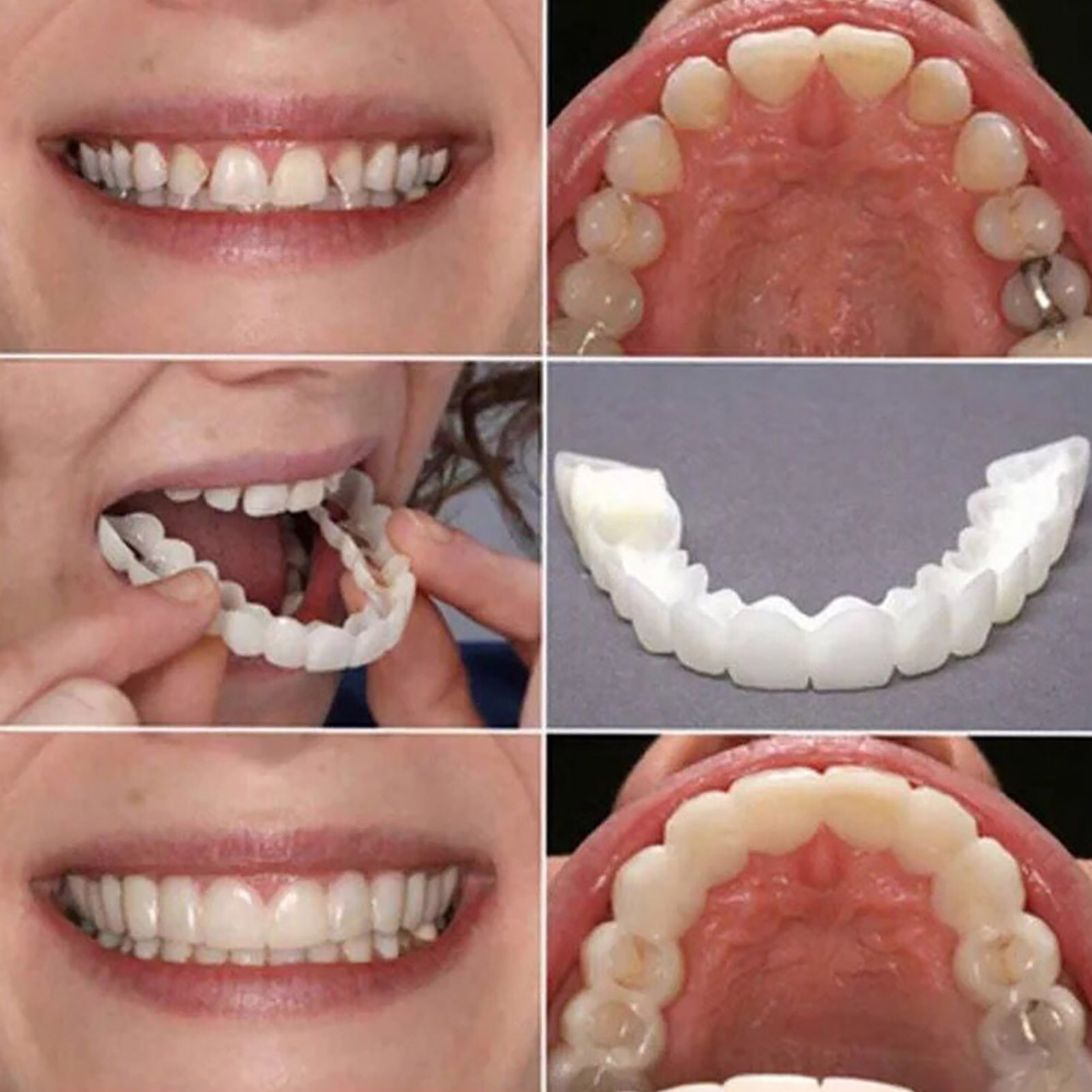 Hot Teeth Veneers Whitening De - đánh giá và giá Teeth Whitening For Braces