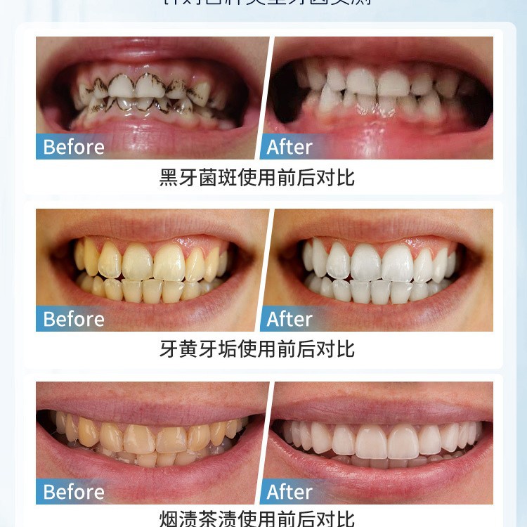 Japan Manual Tooth Stain Remov - đánh giá và giá Teeth Whitening Japan